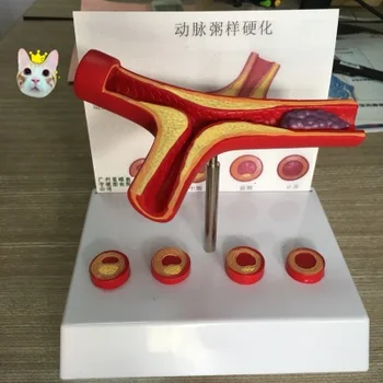 

Human atherosclerosis Cardiovascular model blood vessel Thrombosis model Human vascular model