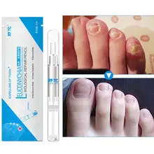 BellyLady антигрибковый Уход за ногтями, жидкая ручка для ухода за пальцами и пальцами