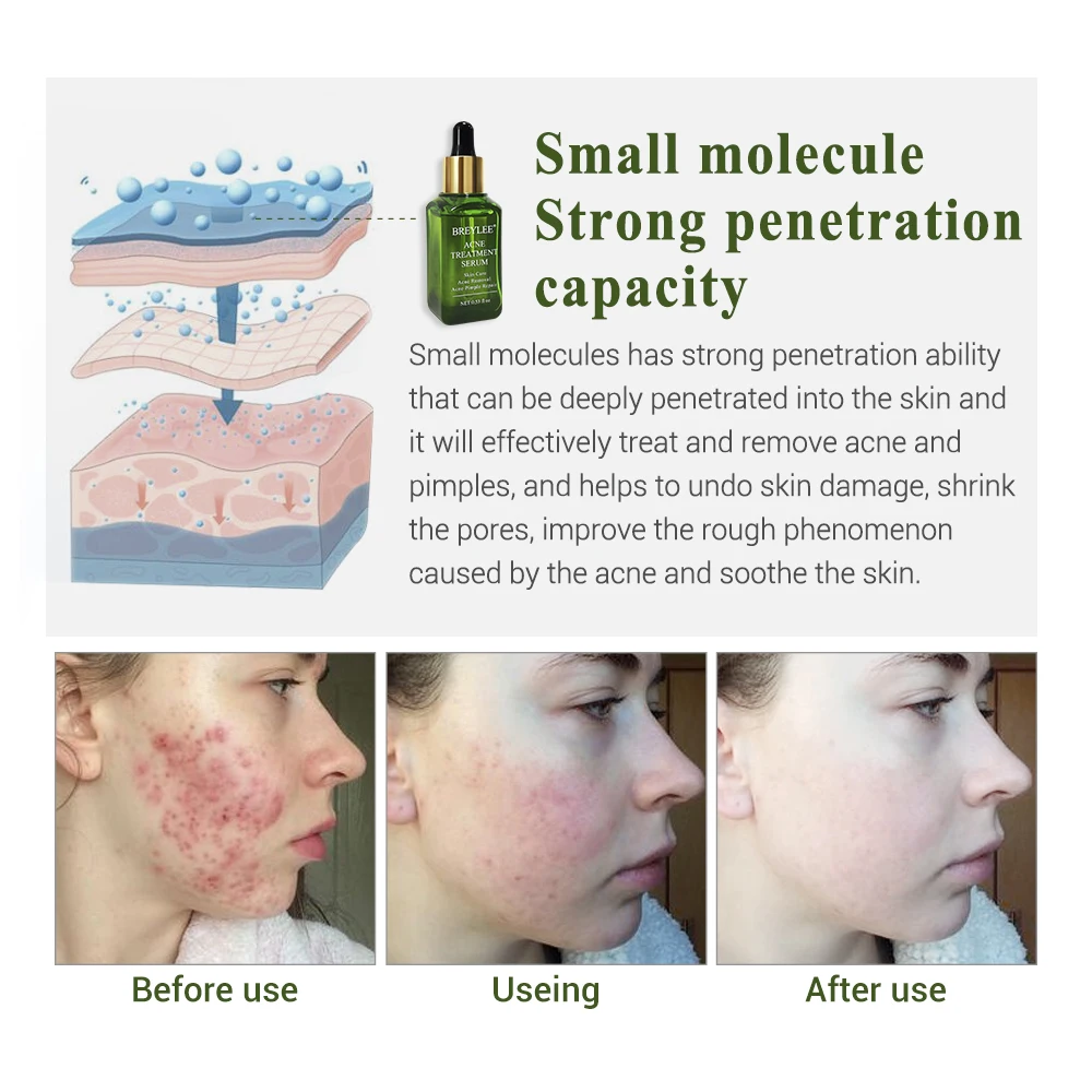 BREYLEE Tea Tree Acne Treatment Serum Essence Facial Anti Acne Scar Removal Cream Repair Pimple Remover Whitening Face Skin Care