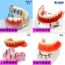 1 шт. x Высокое качество смолы покрытие Зубной Имплантат модель протезы съемные зубы модель для стоматологического исследования Deasin
