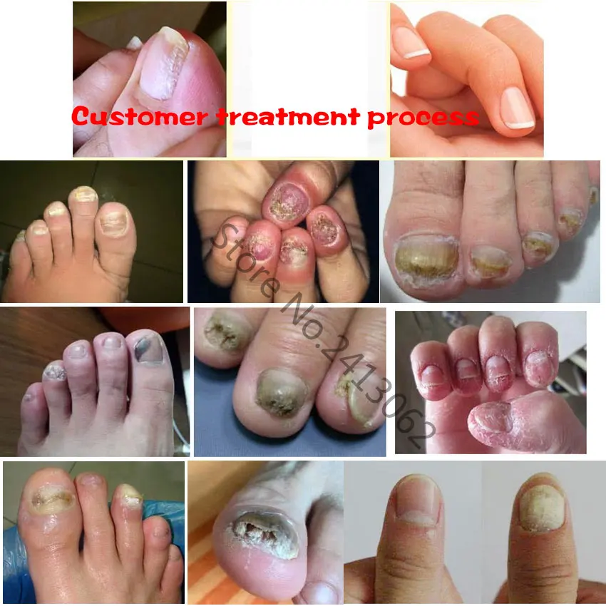 Tratamento de Fungos Unhas do Dedo do pé Unha do Dedo Infecção por Fungo Loção para o Tratamento de Remoção de Cuidados com as Unhas Herbal Essência Anti Unha Nas 4 Online shopping