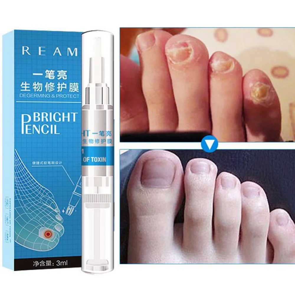 

Toenail Fungus Treatment Pen Onychomycosis Paronychia Anti Fungal Chinese Herbal Toe Nail Fungus Treatment