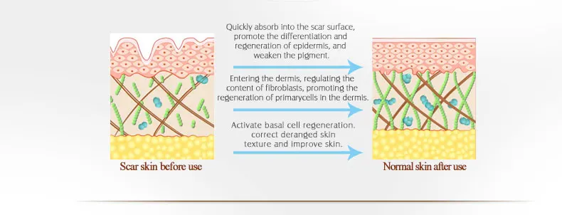 ARTISCARE гель для удаления шрамов и акне TCM лечение черных точек отбеливание делает кожу мягкой гладкой уход за кожей с сывороткой