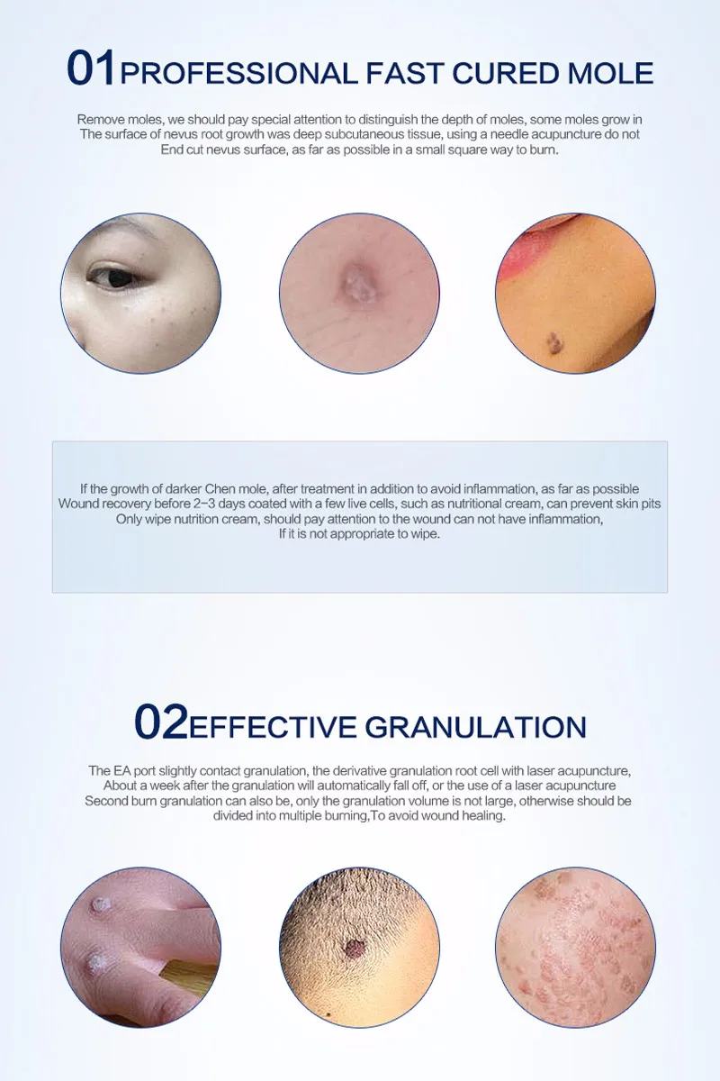 tattoo-removal-machine-11