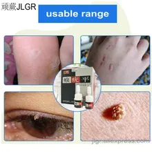 Уход за кожей удаление натоптышей бородавки удаление бородавки красота уход за мозолями средство для удаления бородавки шип пластырь средство для удаления мозолей