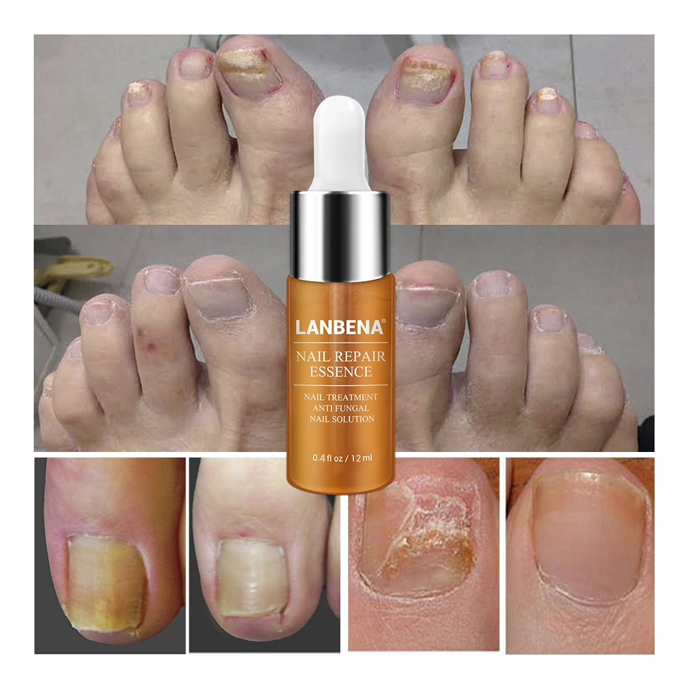 LANBENA 50 средство для восстановления ногтей, сыворотка для лечения грибковых ногтей, для удаления онихомикоза, для ног, для ногтей, питательное, осветляющее, для рук, для ухода за ногами