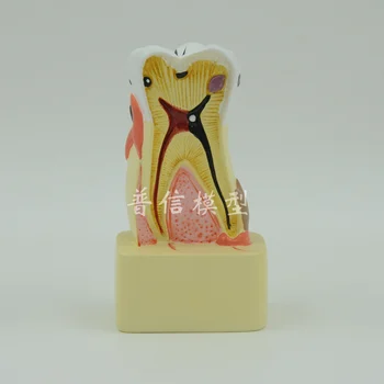 

Dental Pathology Model Anatomical Model Teeth Model Dental Caries Gum Show for Dental Teeth Models Medical Teaching