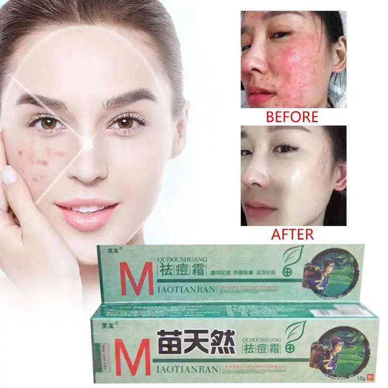 

1pc Original Fuyou Miaotianran Remove Acne Cream Germicidal Remove Mite And Moisturize Your Skin Acne Ointment