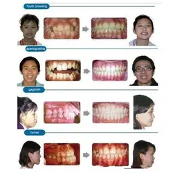 Ортодонтисты невидимые корректирующие брекеты модернизированные Ортодонтические брекеты 88
