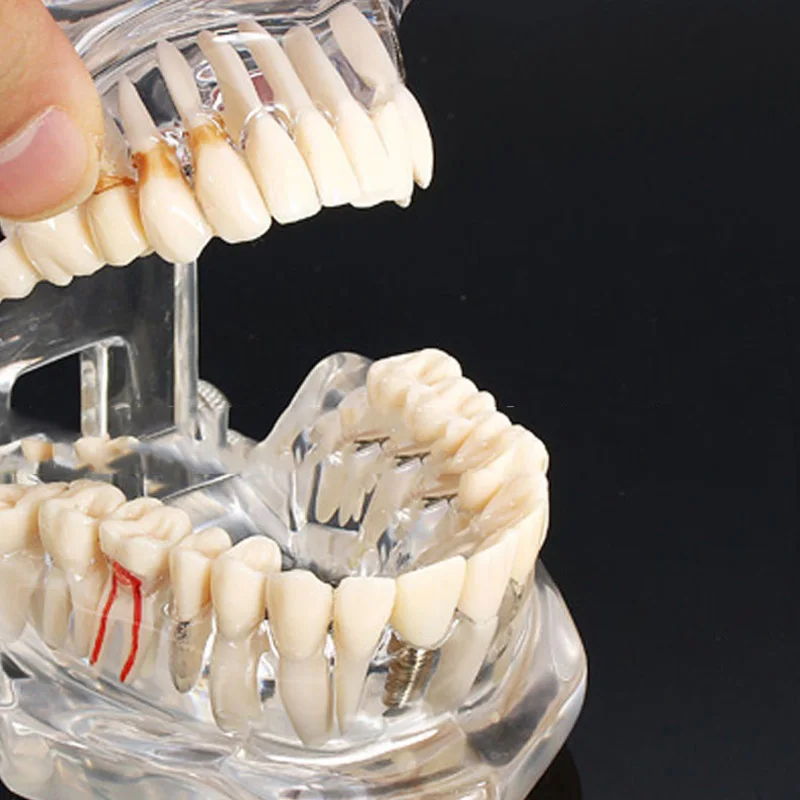 Dental Implant Disease Teeth Model with Restoration Bridge Tooth Dentist for Medical Science Dental Disease Teaching Study
