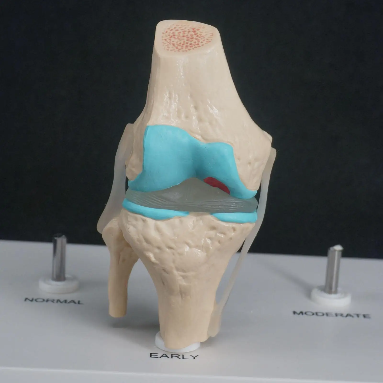 Анатомические модели дегенеративных коленного сустава модель болезни медицинская каркасная модель для изучения анатомии ресурсы