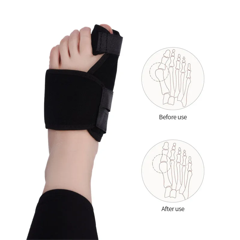 2pc Big Toe Bunion Device Splint Straightener Hallux Valgus Pro Braces