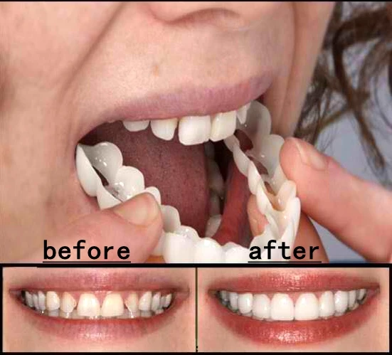

Cosmetic Dentistry Snap On Smile Instant Perfect Smile Comfort Fit Flex Teeth Fits Most False Teeth Upper Tooth Cover Massager