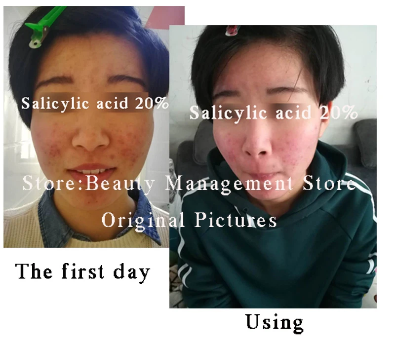 20% peeling com ácido salicílico ácido creme