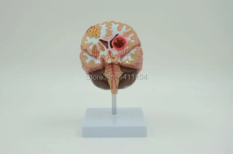 Купить Человеческий мозг анатомическая модель, апоплексический удар ...