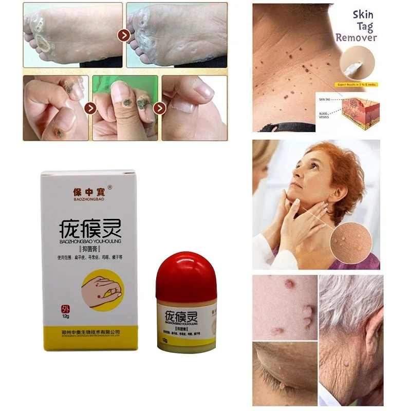

Ultra Strength Skin Tag Remover Foot Corn Skin Tag Wart Remover