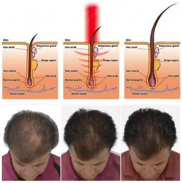 Высокое качество лазер и выпадение волос лечение/650nm лазерный диод рост волос машина DHL