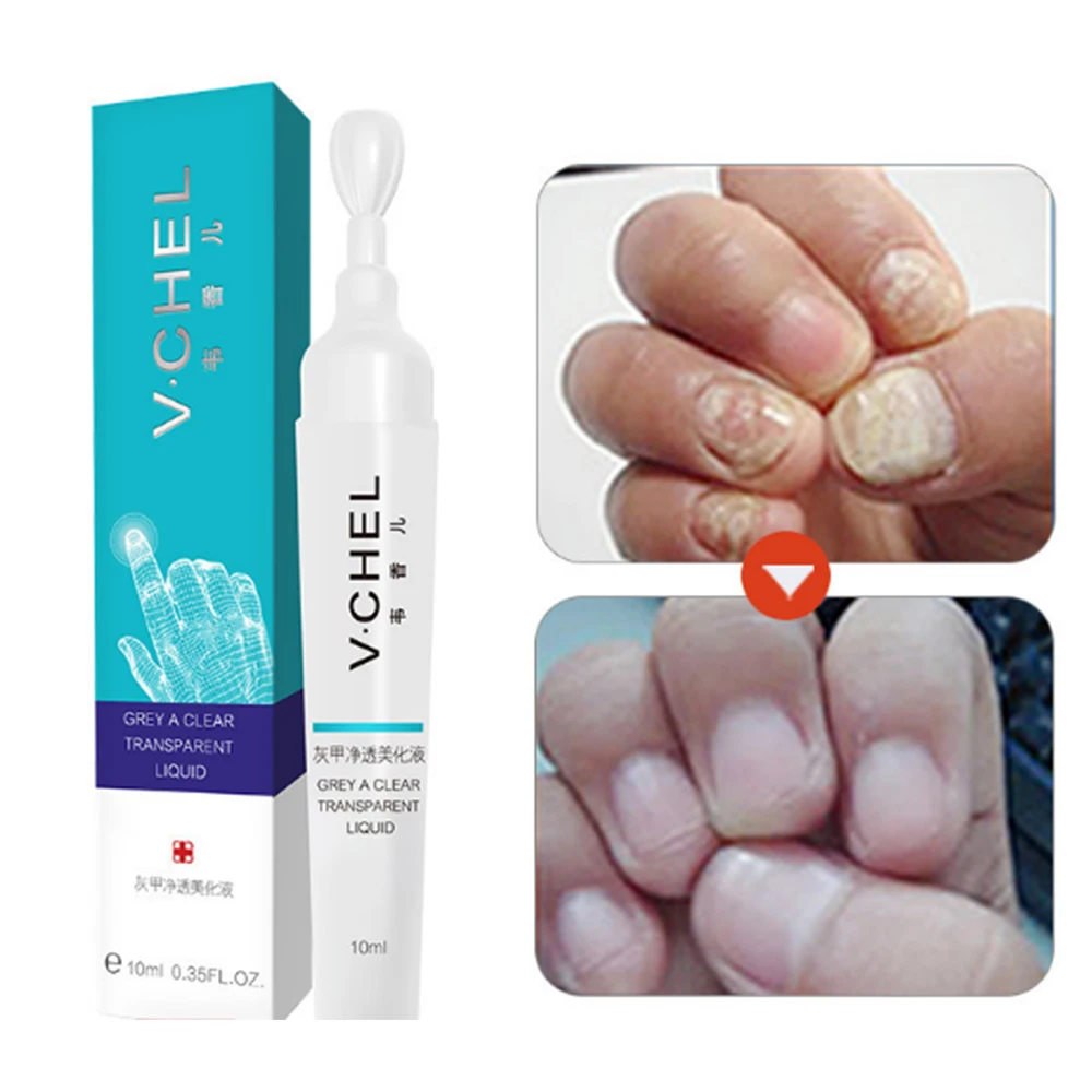 

10ML Fungal Nail Treatment Pen Effective Onychomycosis Paronychia Fungus Infection Repair Solution Gel Fingernails Patch D035