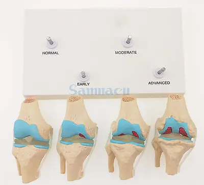 Анатомические модели дегенеративных коленного сустава модель болезни медицинская каркасная модель для изучения анатомии ресурсы