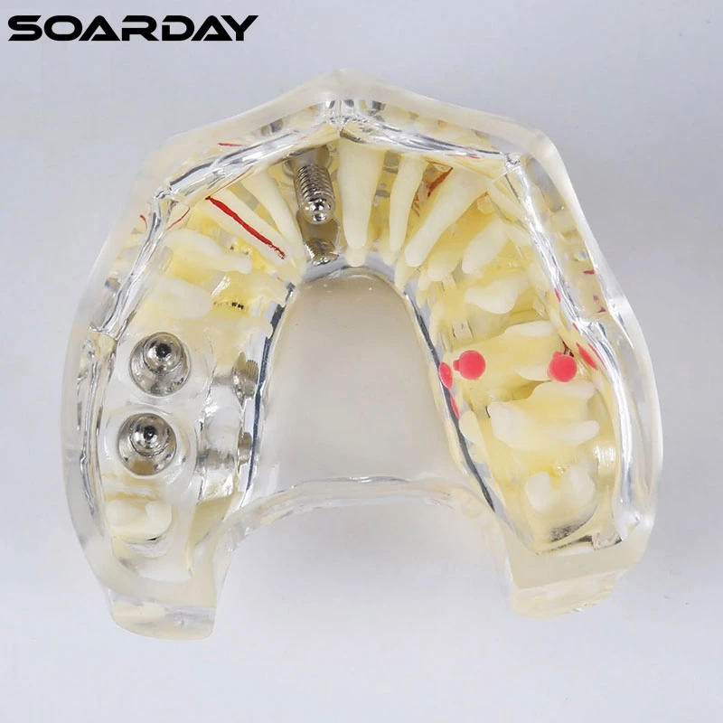 Модель имплантата с мостом и кариес для стоматологической связи зубной зуб зубы анатомическая модель