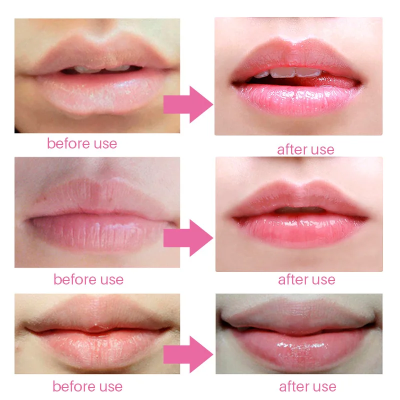 Какое бывает увеличение губ. Формы губ. Форма губ для увеличения. Разновидности губ. Увеличение губ разные формы.