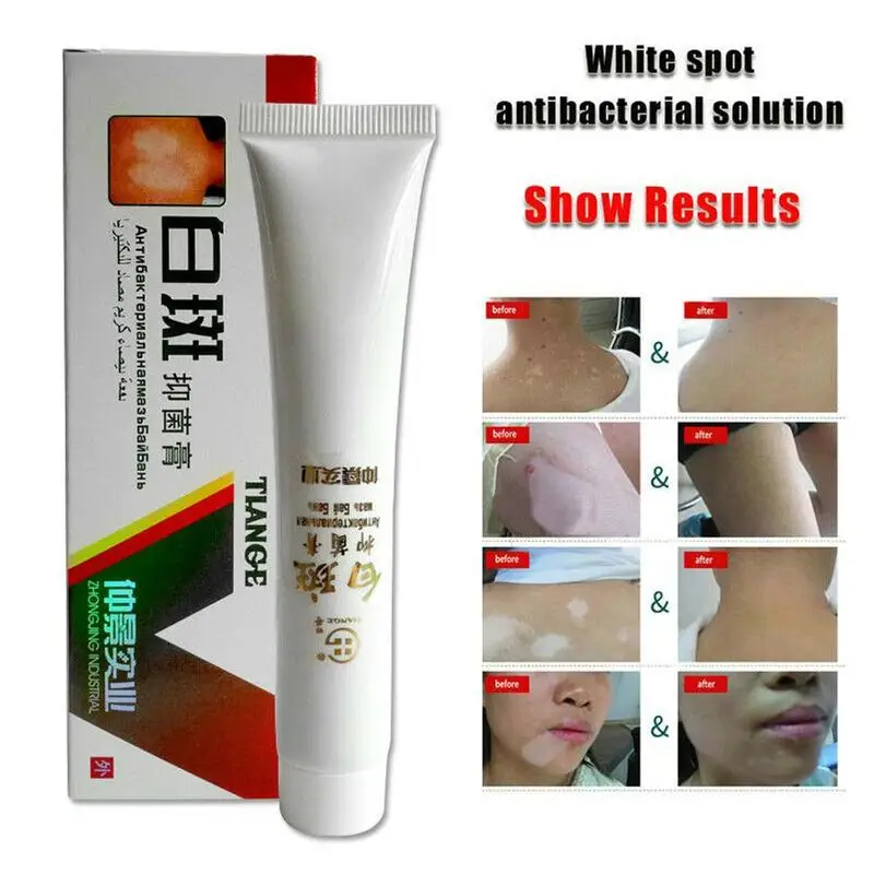 Chinese Medical White Spot Disease Cream Pigment Melanin Promoting Liniment Skin Vitiligo Leukoplakia Treatment 30g/Box | Красота и