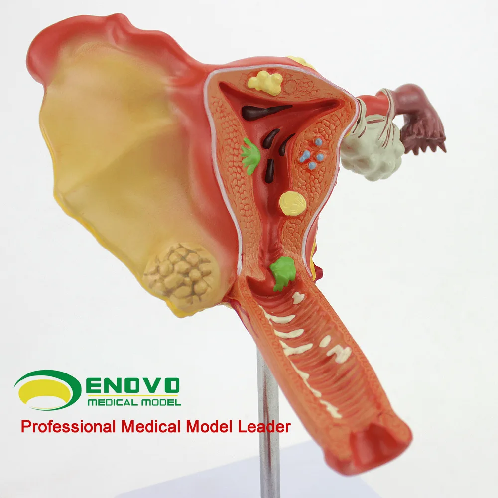 Human Uterine Ovarian Vaginal Disease Model Female Internal and External Reproductive Medicine for Obstetrics and Gynecology
Human Uterine Ovarian Vaginal Disease Model Female Internal and External Reproductive Medicine for Obstetrics and Gynecology
