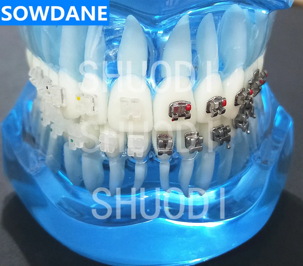 

Blue Transparent Dental Orthodontic Model with Ceramic and Metal Brackets for Patient Communication ( Left Right)