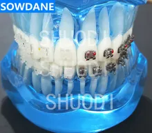 Blue Transparent Dental Orthodontic Model with Ceramic and Metal Brackets for Patient Communication ( Left Right) Blue Transparent Dental Orthodontic Model with Ceramic and Metal Brackets for Patient Communication ( Left Right)