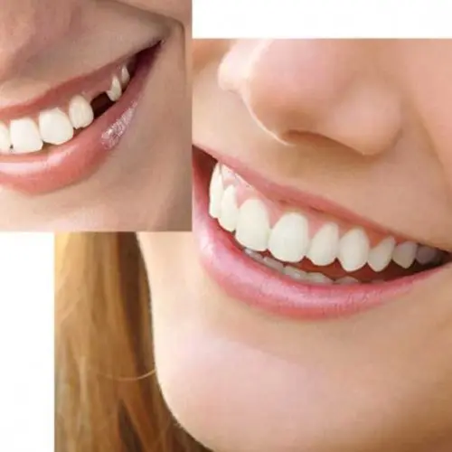 Dental-Veneers-For-Teeth-False-Smile-Veneers-Removable-Veneers-On-Teeth-Instant-Smile-Temporary-Tooth-Fix (5)