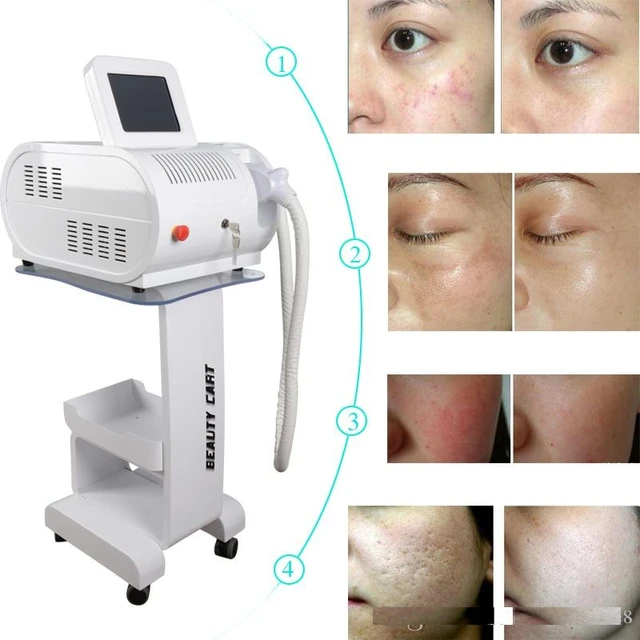 Diferencia Entre Laser Ipl Y Diodo corona.dothome.co.kr