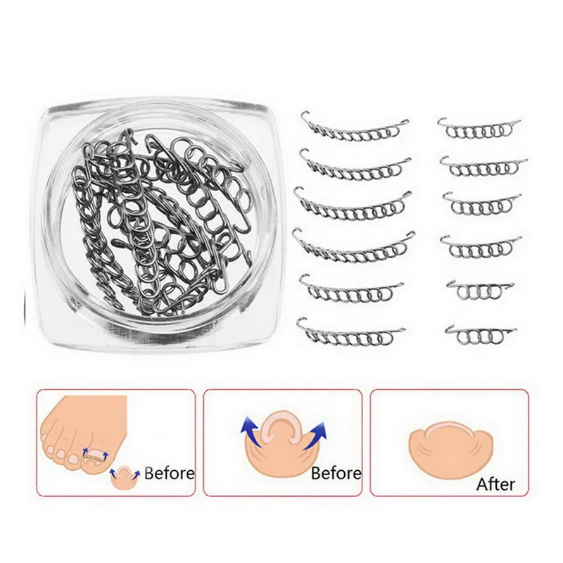 

New Arrivals 12pcs Ingrown Toe Nail Correction Wire Fixer Pedicure Paronychia Recover Toenails Corrector Foot Care Tool #297590