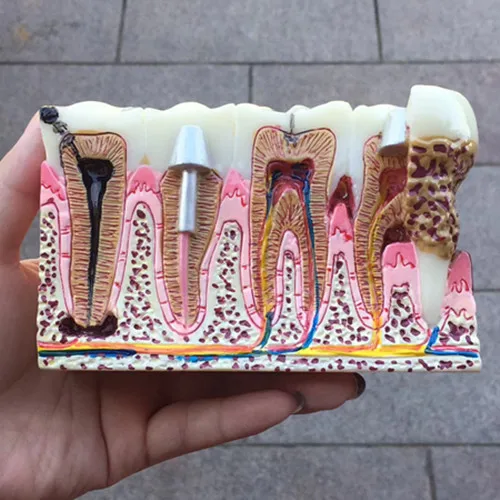 1 шт. Стоматологическая Анатомия кариеса модель зубов демонстрация стоматолога и связи пациента образование модель зубов оборудование