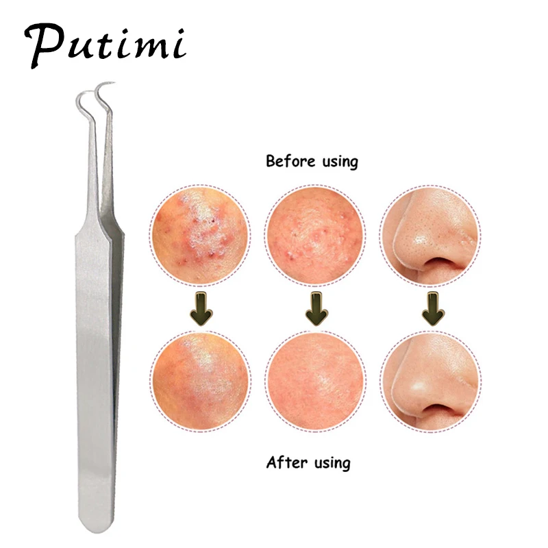 Putimi Blackhead Tweezers Pimples Acne Removal Needle Blemish Comedone