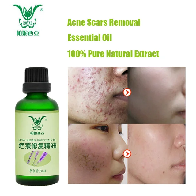 Face Care Essential Oil Acne Scar Spots Removal Skin Care Whitening