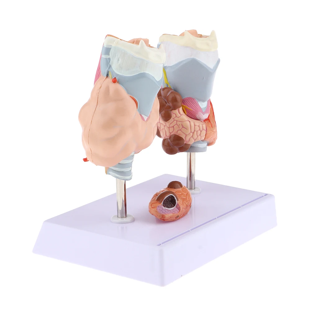 Magnified Human Thyroid Anatomical Model Normal & Diseased With Pathologies For Classroom Study Display Teaching