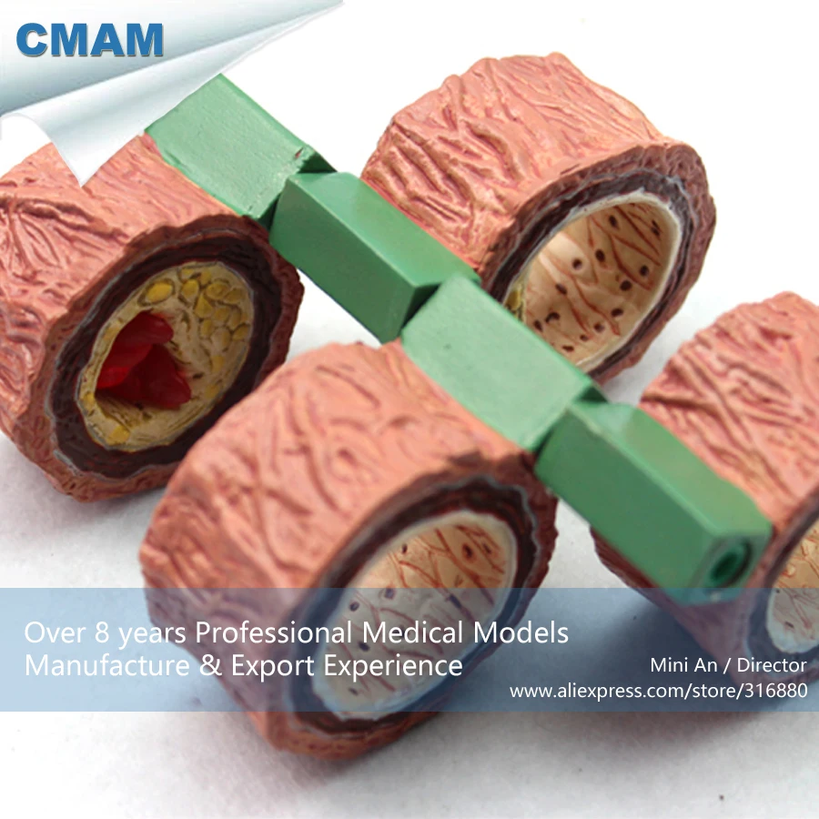 12483/4-х ступенчатый артерии холестерина атеросклероз модель, медицинская научная образовательная анатомическая модели