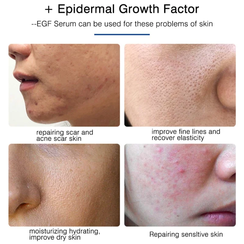 Acne удаление эссенции 40 г натуральный Замораживание-сушеный порошок восстанавливающая сыворотка Эпидермальный фактор роста Удаление