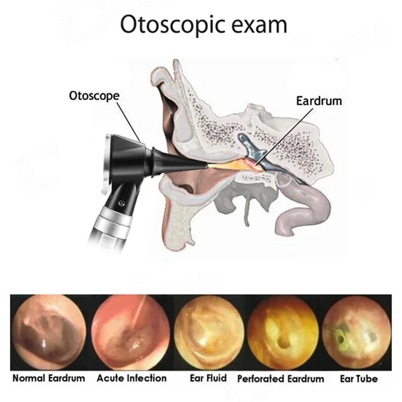 Профессиональная диагностическая Otoscope волоконно-оптическая медицинская широкая полевая Диагностика уха