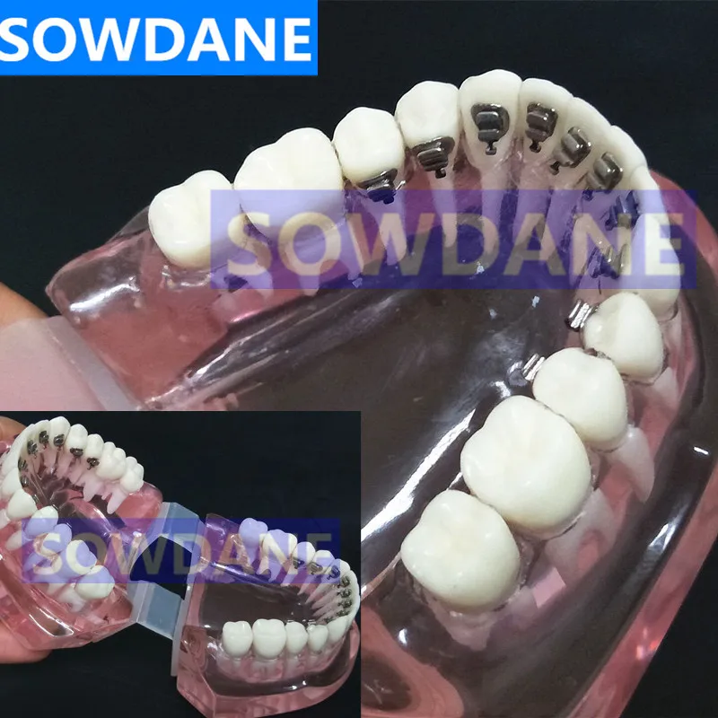 

Dental Orthodontic Model With Lingual Brackets for Dentist-Patient Communication Study Transparent Tooth Model