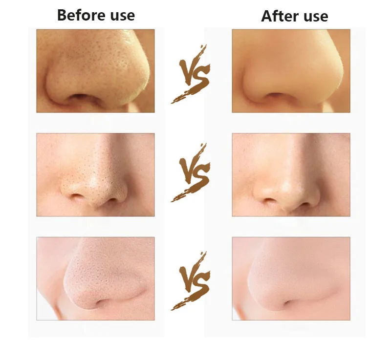 Purificador da Pele Máquina de Peeling Ultrasonic Facial Acne Cravo Remoção Vibração Massageador Esfoliante pá Limpa Hot 8 HOT Ultrasonic Purificador Da Pele Facial Acne