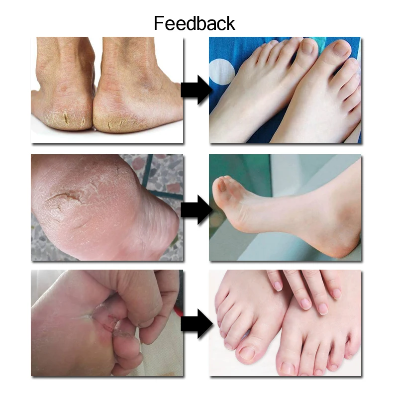 shea butter for cracked feet
