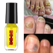 1 бутылочка 5 мл грибковая эссенция для удаления жидких грибковых ногтей яркий ремонт ногтей анти-инфекция Уход за ногами масло онихомикоза