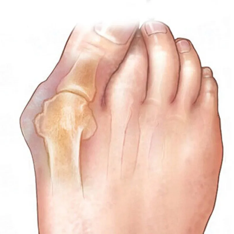 1 пара LittleToe мизинец большого пальца для ежедневного использования Hallux Valgus силиконовый разделитель для большого пальца накладка против