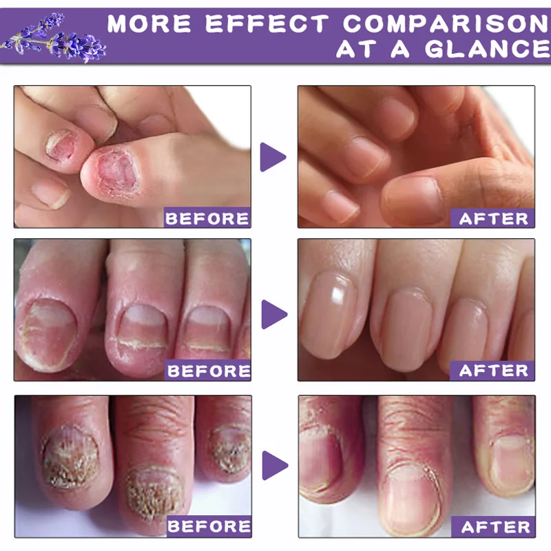 Effective Nail Fungus Treatment Anti Fungal Toenail Repair Lavender Essential Oil Nail Care Onychomycosis Treatment Liquid JLRS8 Effective Nail Fungus Treatment Anti Fungal Toenail Repair Lavender Essential Oil Nail Care Onychomycosis Treatment Liquid JLRS8