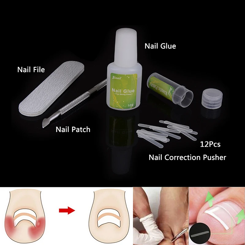 Ingrown Toenail Correction Kit Toenail Treatment Nail Glue Toenail