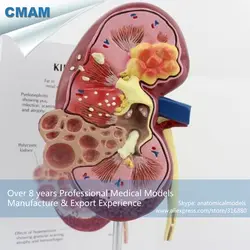 12432 cmam-kidney03 Анатомия человека больные почек модель с карты, Медицинские товары учебных анатомические модели
