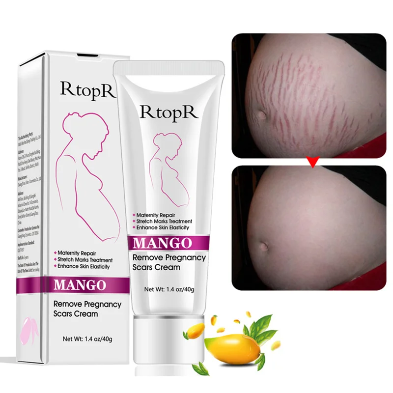 RtopR Natural Mild Non-irritating Mango Stretch Mark Cream Pregnancy Repair Scar Slack Line Abdomen Stretch Marks Cream TSLM1