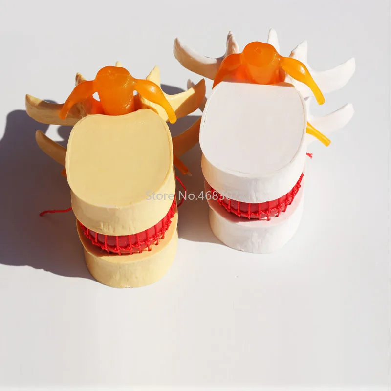 Human Anatomy Skeleton Spine Lumbar Disc Herniation Teaching Model Brain Skull Traumatic Pistol School Supplies Medical Instrume medical head model medical lumbar disc model
