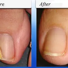 Лечение грибка ногтей для пальцев ног и пальцев ногтей грибковые инфекции-#1 естественное лечение